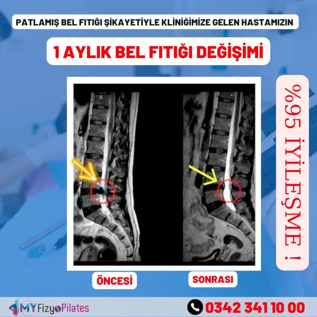 Bel Fıtığı Tedavisi Öncesi Sonrası Görüntü